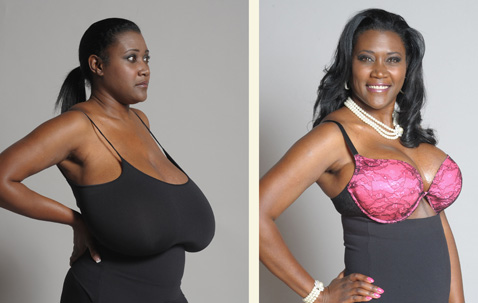 Woman crowdfunds 10GG breast reduction