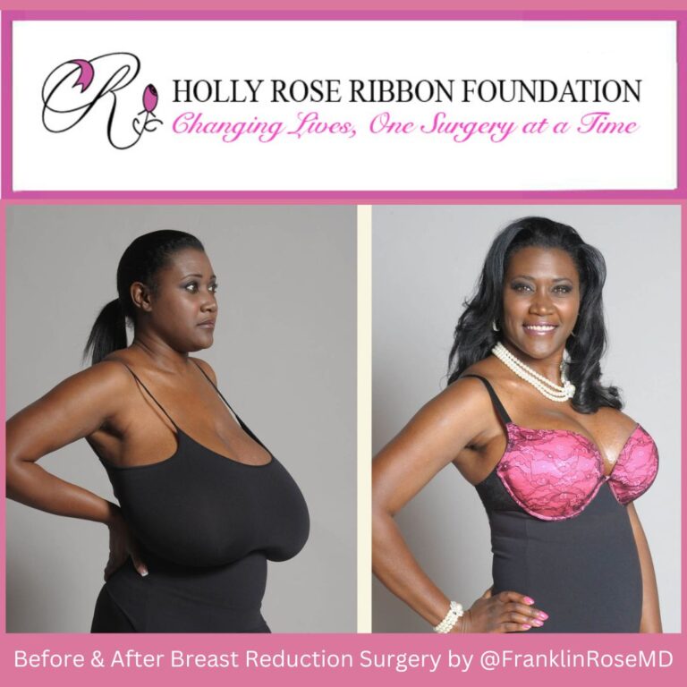 Breast Reduction-October Breast Cancer Awareness Month