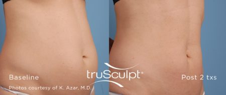 truSculpt Body 6