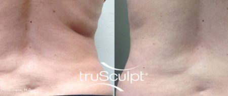 truSculpt