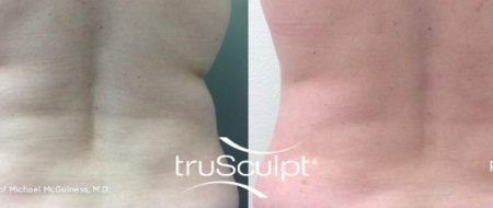 truSculpt back