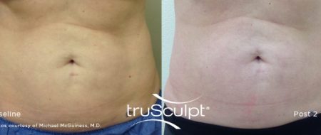 truSculpt tummy 5