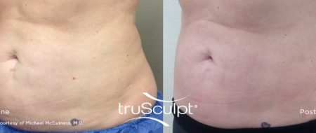 truSculpt tummy 2