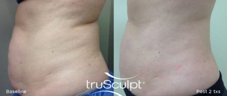 truSculpt tummy