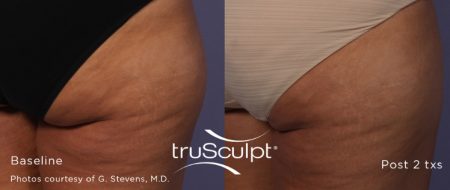 truSculpt 4