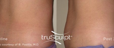 truSculpt Body